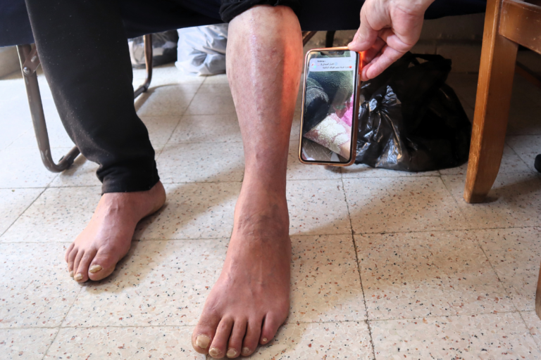 «Ma peau a été complètement brûlée» : au Liban, les ravages du phosphore blanc, largué illégalement par l’armée israélienne
